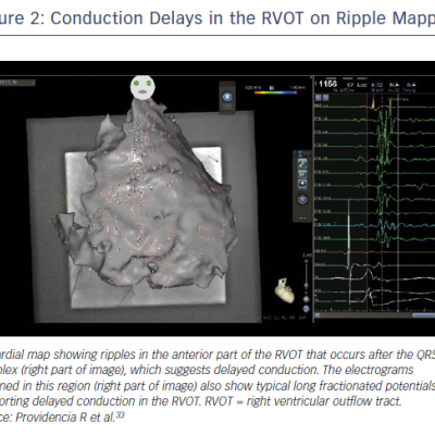 Figure 2 Conduction Delays in the RVOT on Ripple Mapping