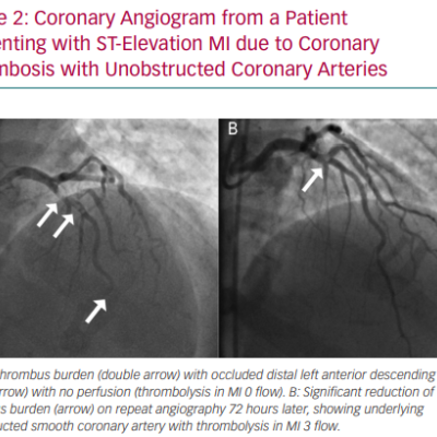 Coronary Angiogram from a Patient Presenting