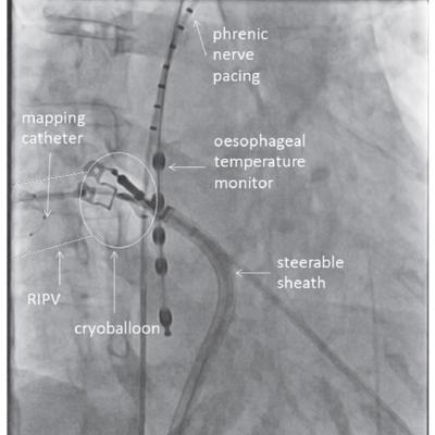 Figure 2 Cryoballoon Ablation of the Right Inferior Pulmonary Vein using the Direct Approach