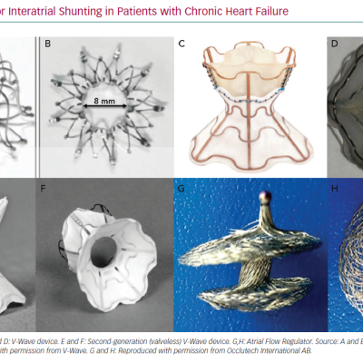 Devices used for Interatrial Shunting in Patients with Chronic Heart Failure