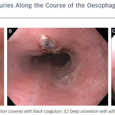 Figure 2 Different Extent of Thermal Injuries Along the Course of the Oesophagus of Different Patients who Underwent Radiofrequency Ablation