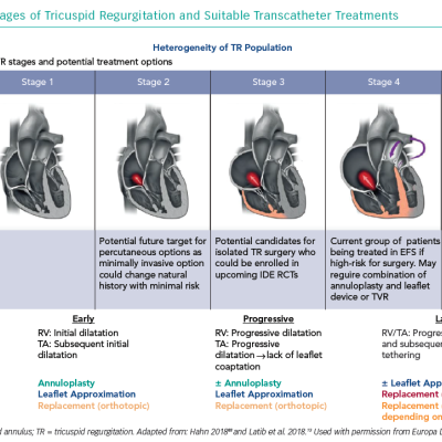 Different Stages of Tricuspid Regurgitation and Suitable Transcatheter Treatments