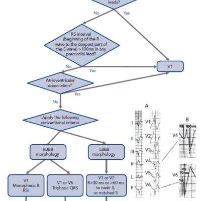 Differential Diagnosis of Wide QRS Tachycardia using the Brugada et al. Algorithm