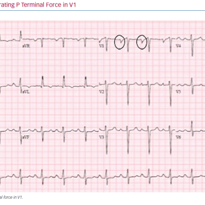 ECG Demonstrating P Terminal Force in V1