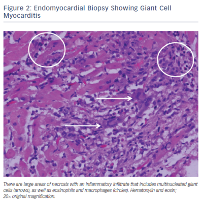Figure 2 Endomyocardial Biopsy Showing Giant Cell Myocarditis