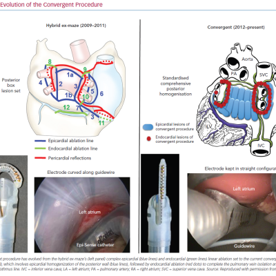 Evolution of the Convergent Procedure