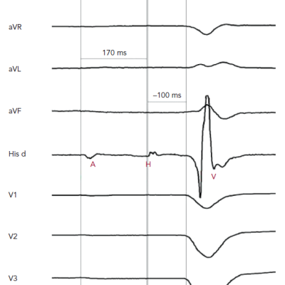 Example of Results of an Electrophysiological Study