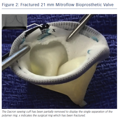 Figure 2 Fractured 21 mm Mitroflow Bioprosthetic Valve