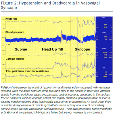 Figure 2 Hypotension and Bradycardia in Vasovagal Syncope