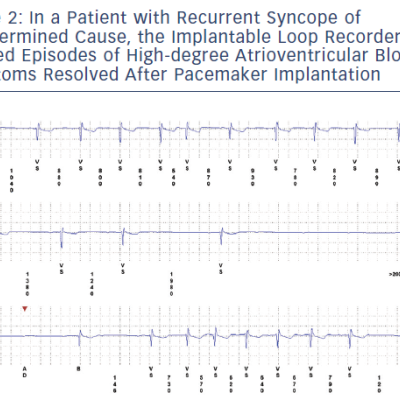 Figure 2 In A Patient With Recurrent Syncope Of Undetermined Cause The Implantable Loop Recorder Showed Episodes Of High-Degree Atrioventricular Block. Symptoms Resolved After Pacemaker Implantation
