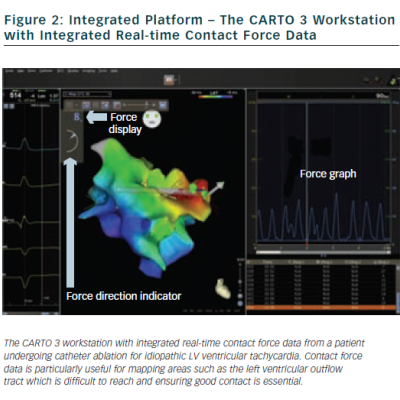 Figure 2 Integrated Platform – The CARTO 3 Workstation with Integrated Real-time Contact Force Data
