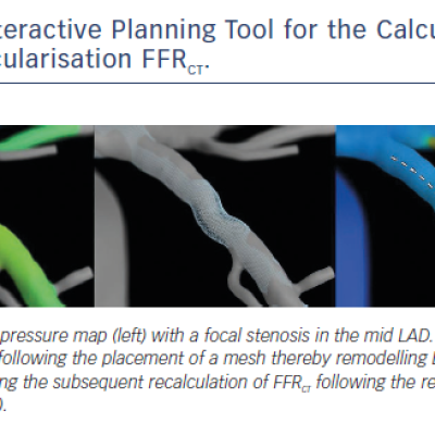 Figure 2 Interactive Planning Tool for the Calculation of Post Revascularisation FFRCT