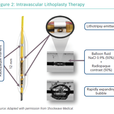 Intravascular Lithoplasty Therapy