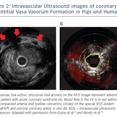 Figure 2 Intravascular Ultrasound images of coronary adventitial Vasa Vasorum Formation in Pigs and Humans