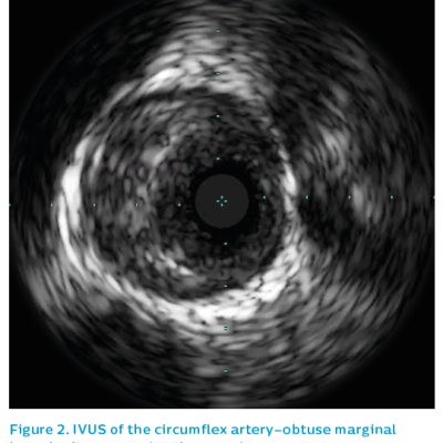 Figure 2. IVUS of the circumflex artery–obtuse marginal branch after reopening the vessel