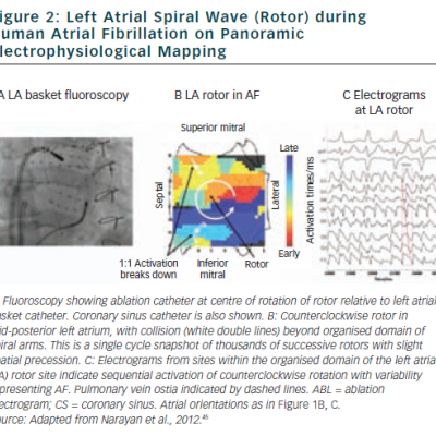 Figure 2 Left Atrial Spiral Wave Rotor during  Human Atrial Fibrillation on Panoramic Electrophysiological Mapping