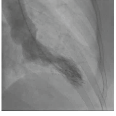 Figure 2. Left ventricular angiography
