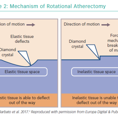 Mechanism of Rotational Atherectomy