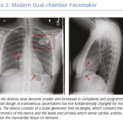 Modern Dual-chamber Pacemaker