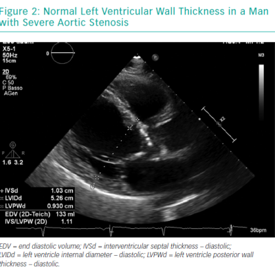 Normal Left Ventricular Wall Thickness in a Man with Severe Aortic Stenosis