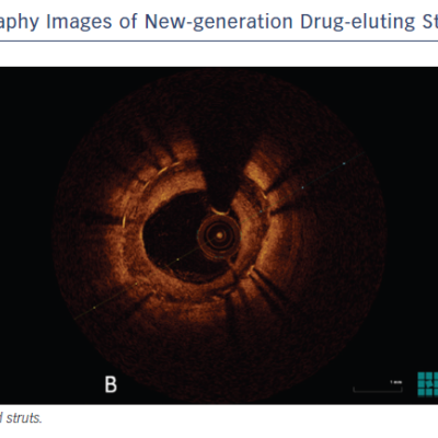 Figure 2 Optical Coherence Tomography Images of New-generation Drug-eluting Stents