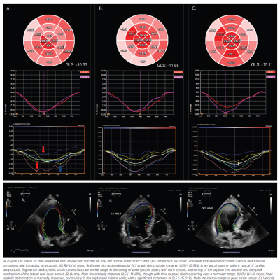 Optimisation of CRT with Adaptive CRT and Speckle Tracking Strain Imaging in Non-responders