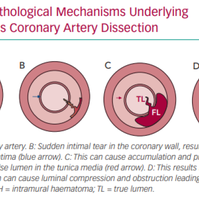 Pathological Mechanisms Underlying Spontaneous Coronary Artery Dissection