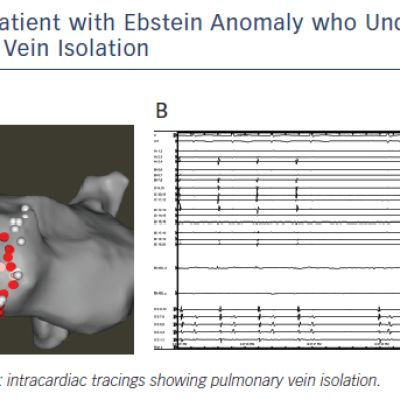 Figure 2 Patient with Ebstein Anomaly who Underwent Pulmonary Vein Isolation