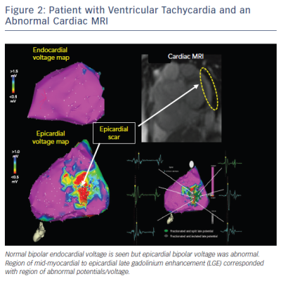 Patient with Ventricular Taachycardia &ampamp ab Abnormal Cardic MRI
