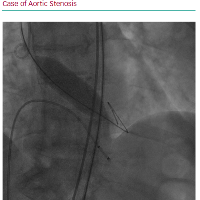 Percutaneous Balloon Aortic Valvuloplasty in a Case of Aortic Stenosis