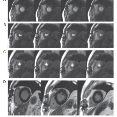 Perfusion in Four Consecutive Cardiac Cycles