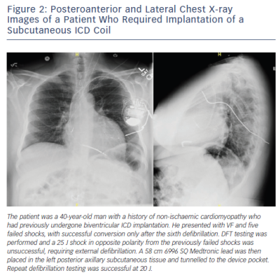 Posteroanterior and Lateral Chest X-ray Images of a Patient Who Required Implantation of a Subcutaneous ICD Coil