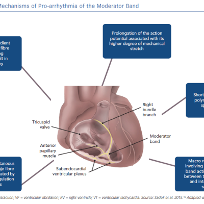 Potential Mechanisms of Pro-arrhythmia of the Moderator Band