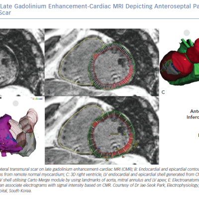 Pre-procedural Late Gadolinium Enhancement-Cardiac