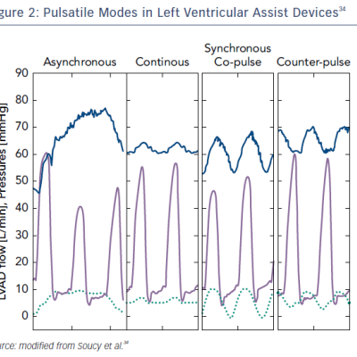 Figure 2 Pulsatile Modes in Left Ventricular Assist Devices