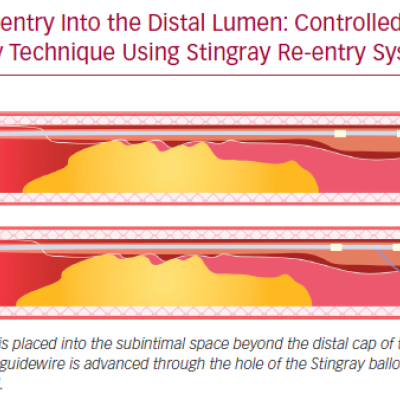 Re-entry Into the Distal Lumen