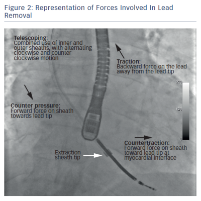 Representation of Forces Involved in Lead Removal