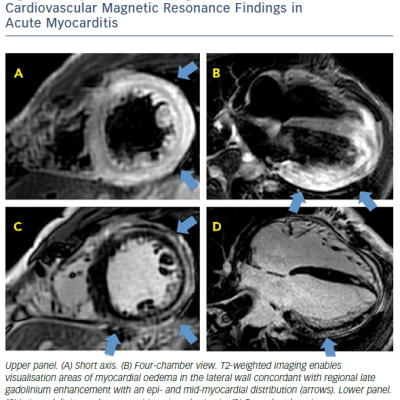 Figure 2 Representative Images Of Conventional Cardiovascular Magnetic Resonance Findings In Acute Myocarditis