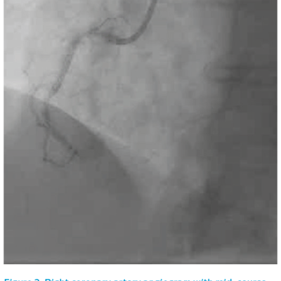 Figure 2. Right coronary artery angiogram with mid-course occlusion