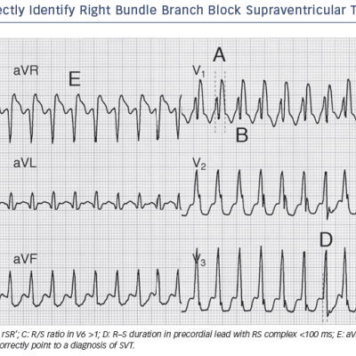Figure 2 Several Criteria Correctly Identify Right Bundle Branch Block Supraventricular Tachycardia