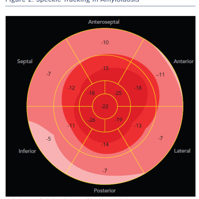 Figure 2 Speckle Tracking in Amyloidosis