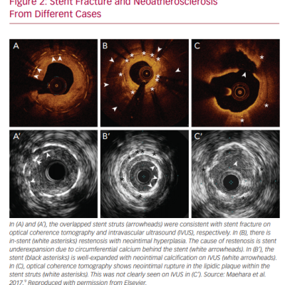 Stent Fracture and Neoatherosclerosis From Different Cases