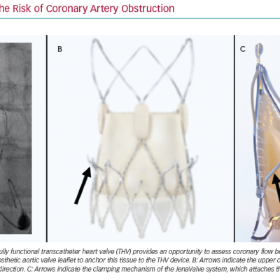 Strategies to Lower the Risk of Coronary Artery Obstruction
