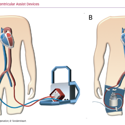 Temporary Ventricular Assist Devices