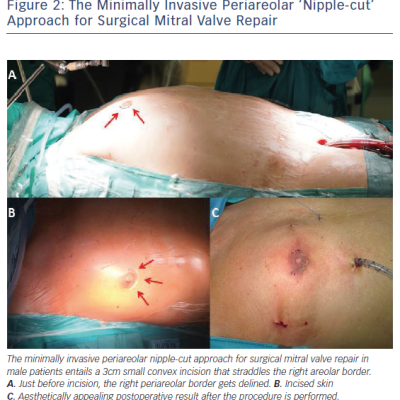 Figure 2 The Minimally Invasive Periareolar ‘Nipple-cut’ Approach for Surgical Mitral Valve Repair