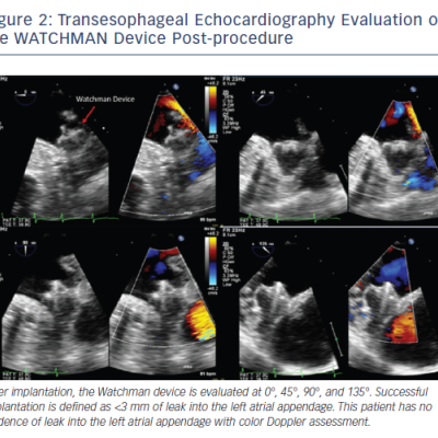 Figure 2 Transesophageal Echocardiography Evaluation of the WATCHMAN Device Post-procedure