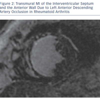Transmural MI of the Interventricular Septum