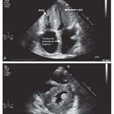 Transthoracic Echocardiogram for a Patient with Biopsy-proven Amyloidosis Showing a Sparkling Appearance with Severe Left Ventricular Hypertrophy and Right Ventricular Hypertrophy