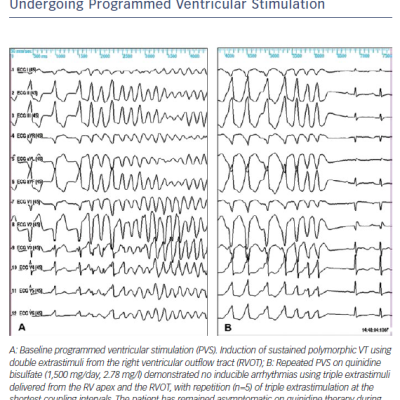 Figure 2 Twelve-lead ECG of a Man Aged 38 Years Undergoing Programmed Ventricular Stimulation