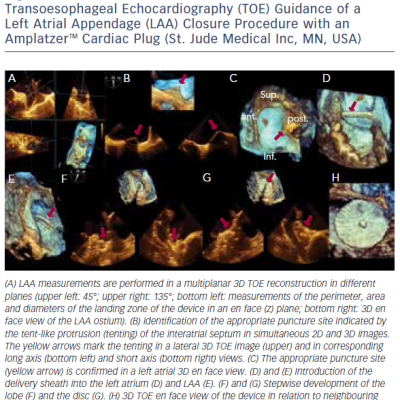 Figure 2 Two- and Three-dimensional 2D/3D Transoesophageal Echocardiography TOE Guidance of a Left Atrial Appendage LAA Closure Procedure with an AmplatzerTM Cardiac Plug St. Jude Medical Inc MN USA